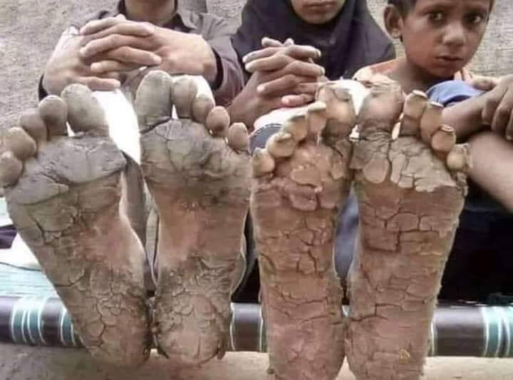 ಕೊರೋನಾದಿಂದ ನೂರಾರು ಮೈಲಿಗಳು ನಡೆದ ಜನರ ಪಾದಗಳು…