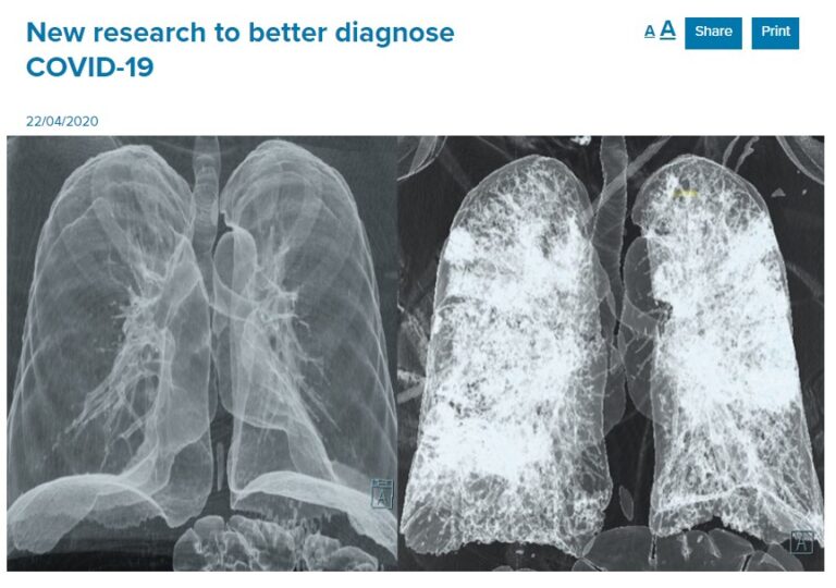 ಫ್ಯಾಕ್ಟ್‌ಚೆಕ್: ಇದು ಕೊರೊನಾ ಲಸಿಕೆ ಪಡೆದ ವ್ಯಕ್ತಿಯ ಶ್ವಾಸಕೋಶದ ಸಿಟಿ ಸ್ಕ್ಯಾನ್ ಚಿತ್ರವಲ್ಲ