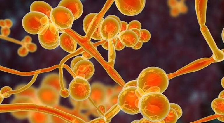 ದೇಶಕ್ಕೆ ಕಾಲಿಟ್ಟ ಯೆಲ್ಲೋ ಫಂಗಸ್: ದೆಹಲಿಯಲ್ಲಿ ಮೊದಲ ಪ್ರಕರಣ ಪತ್ತೆ