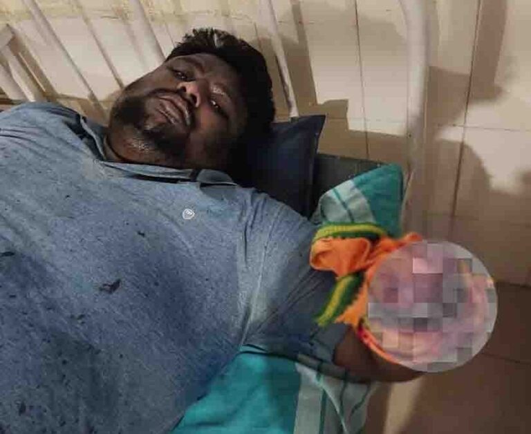 ಡಿಸಿಎಂ ಸ್ವಕ್ಷೇತ್ರದಲ್ಲಿ ದಲಿತ ಯುವಕನ ಕೈ ಕತ್ತರಿಸಿದ ಬಲಾಢ್ಯ ಜಾತಿ ಗುಂಪು; ಗಡಿಪಾರಾಗಿದ್ದ ರೌಡಿಶೀಟರ್‌ನಿಂದ ದುಷ್ಕೃತ್ಯ